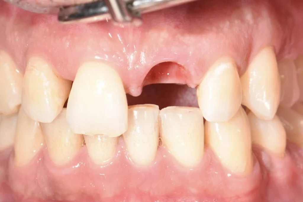 implants dentaires paris 1 1