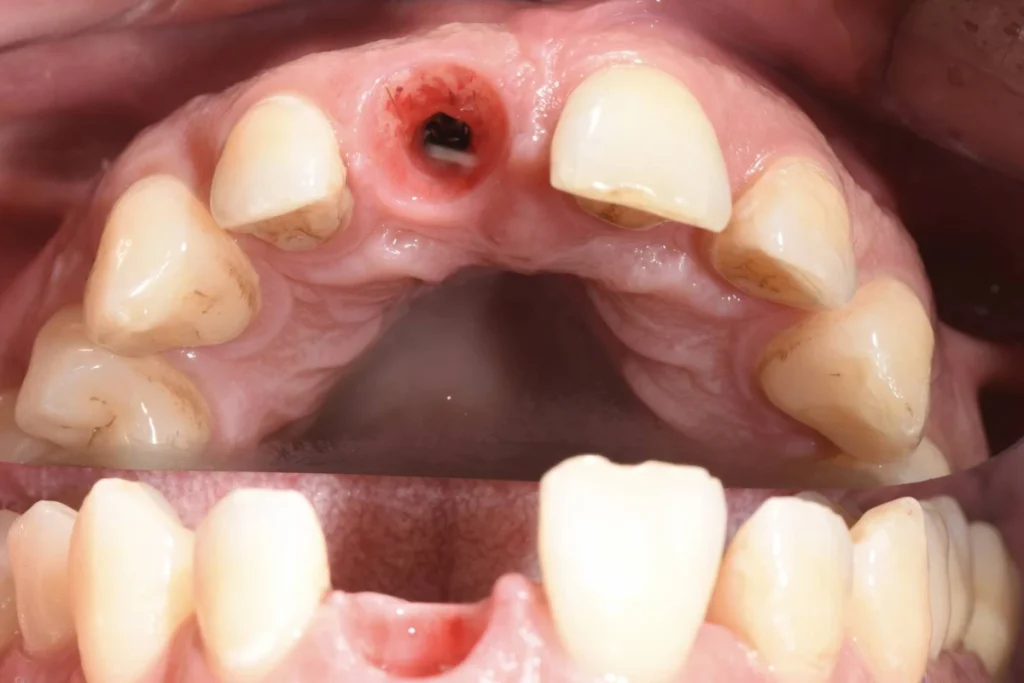 implants dentaires paris 1 2