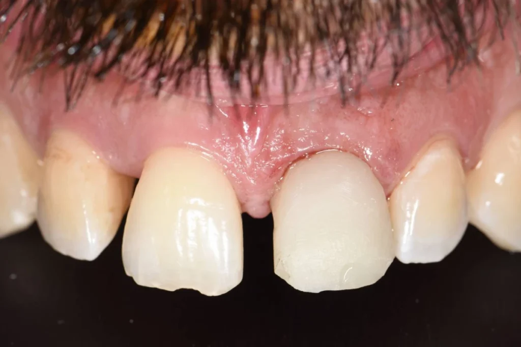 implants dentaires paris 1 3