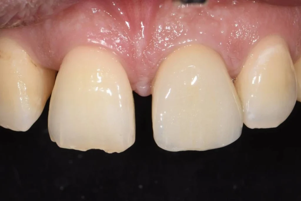 implants dentaires paris 1 4