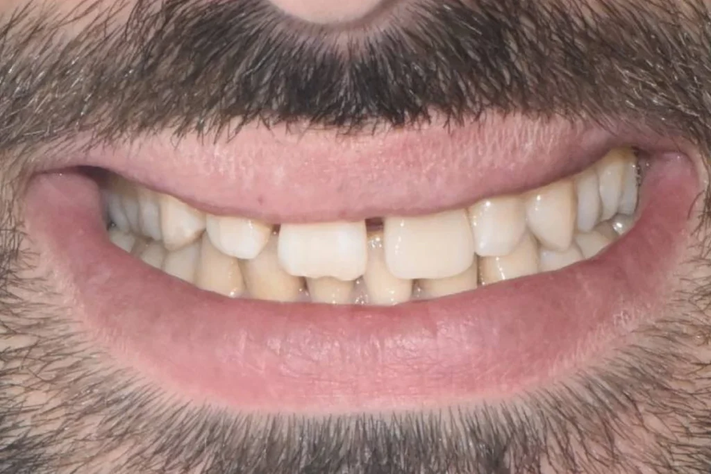 implants dentaires paris 1 5