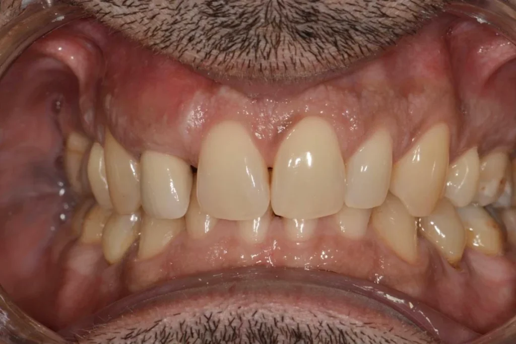 implants dentaires paris 2 1