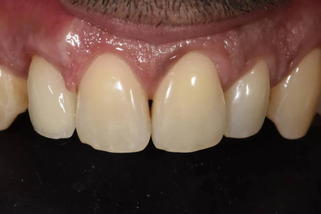 implants dentaires paris 2 2