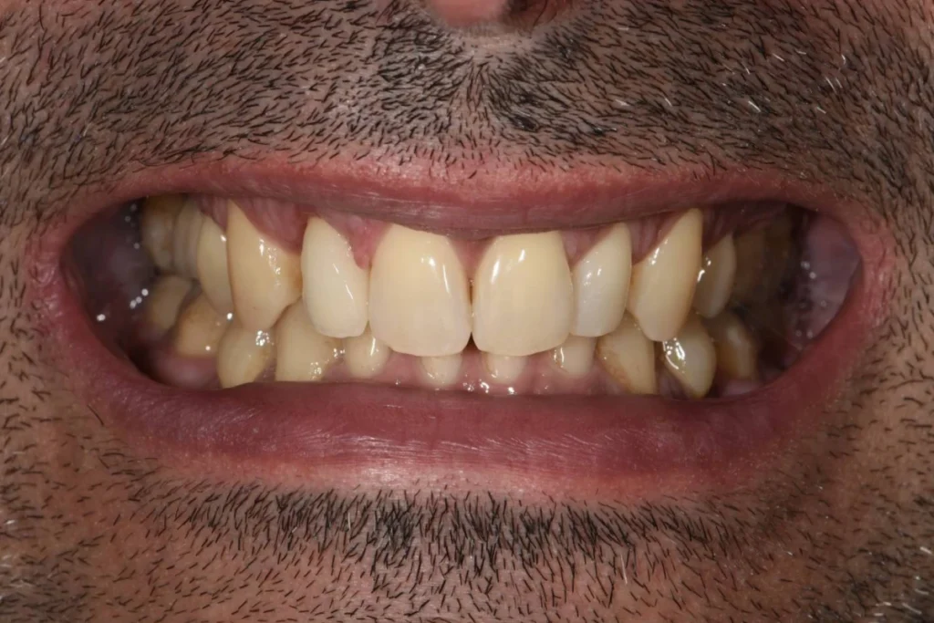 implants dentaires paris 2 3