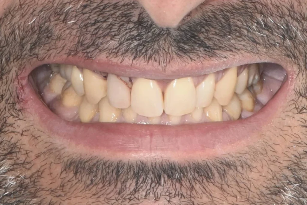 implants dentaires paris 2 4