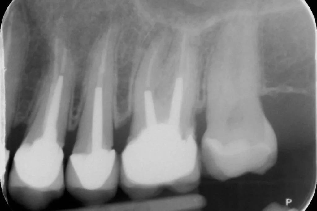 implants dentaires paris 3 1