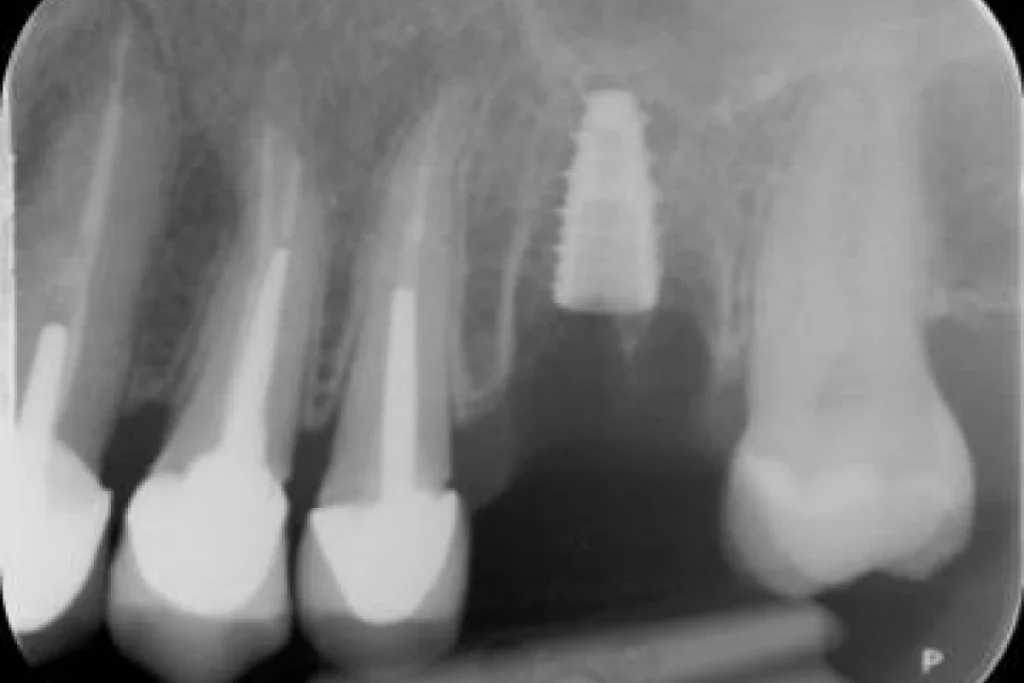 implants dentaires paris 3 2