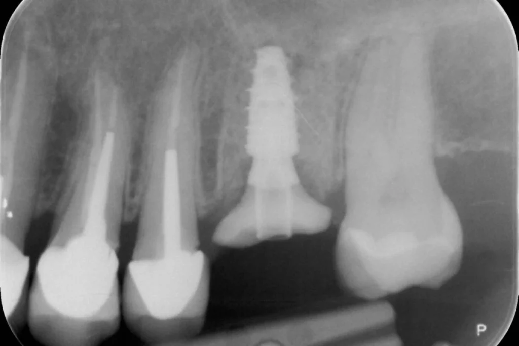 implants dentaires paris 3 3