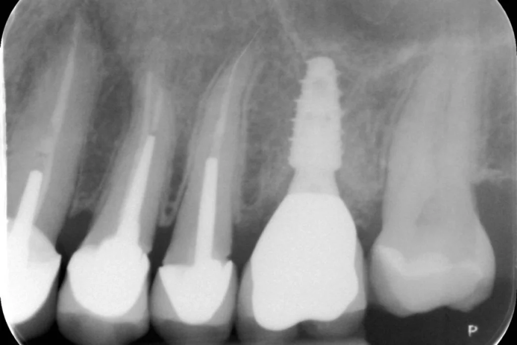 implants dentaires paris 3 4