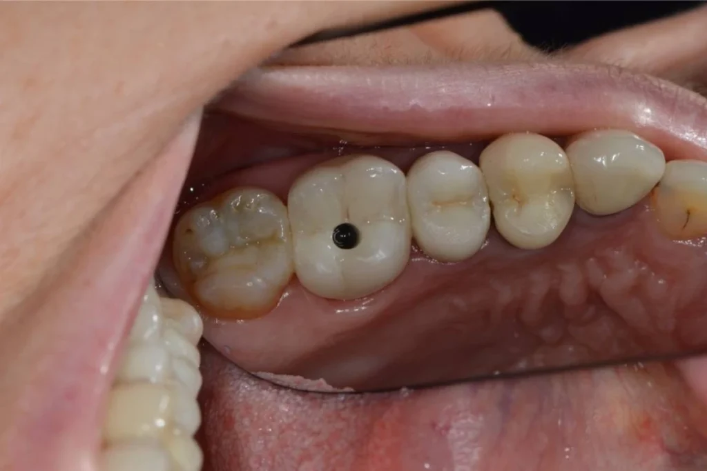 implants dentaires paris 3 6