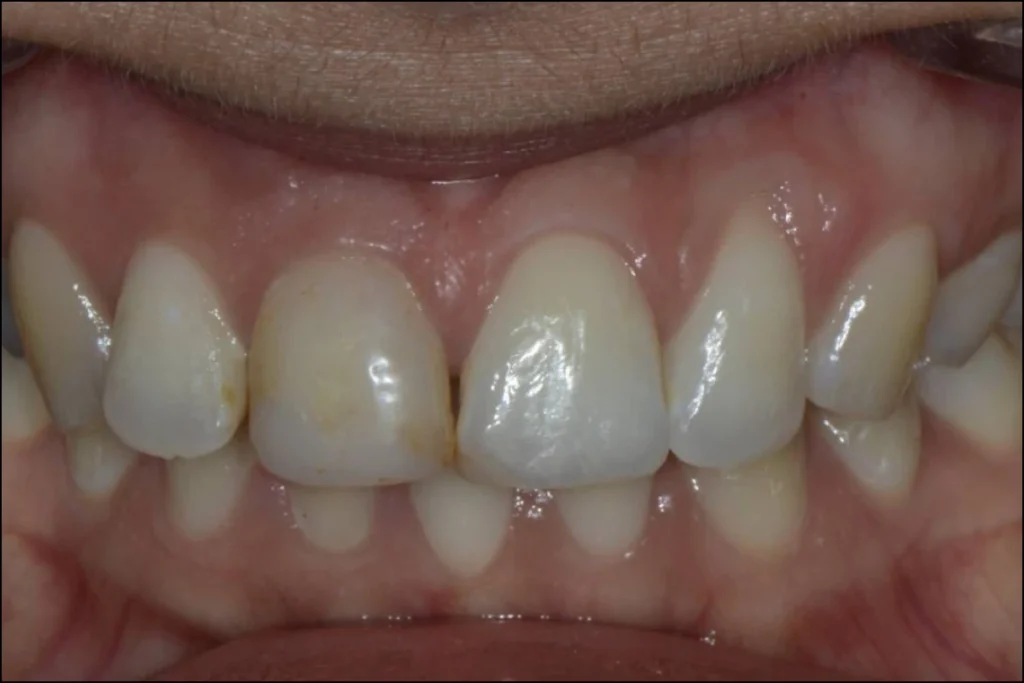 blanchiment orthodontie couronne 1 1