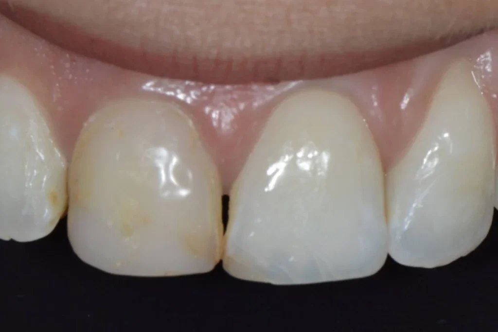 blanchiment orthodontie couronne 1 2