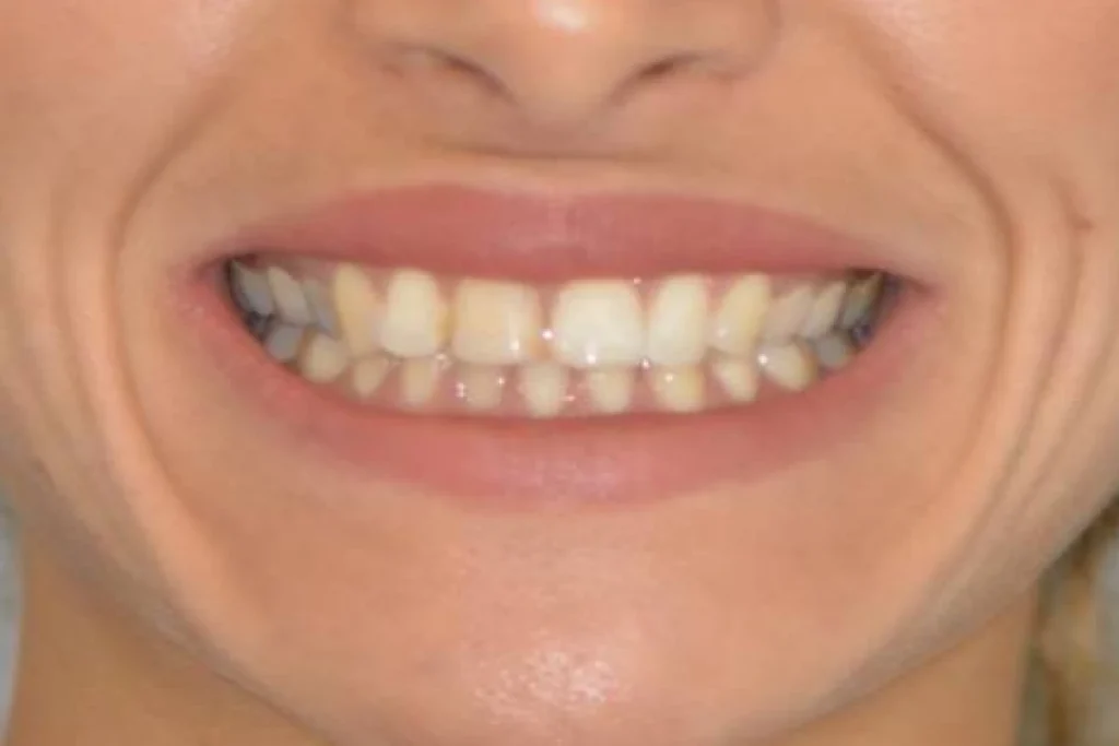 blanchiment orthodontie couronne 1 3