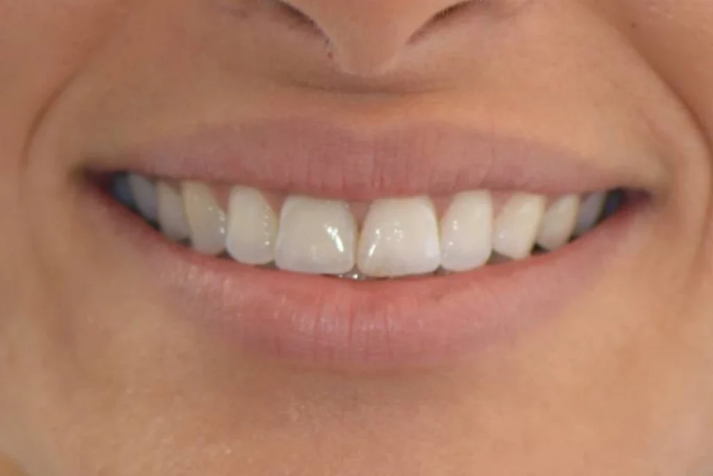 blanchiment orthodontie couronne 1 4