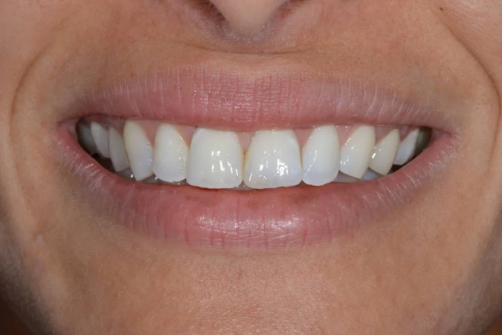 blanchiment orthodontie couronne 1 5