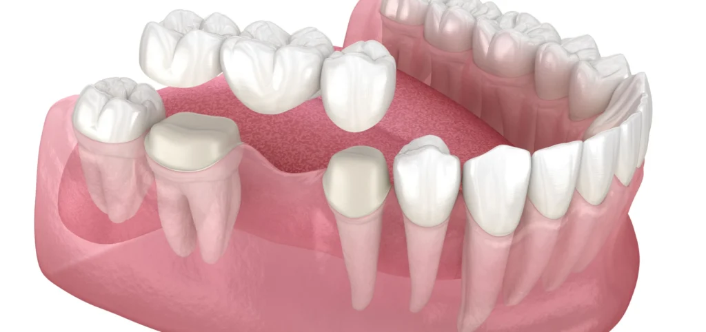 bridge dentaire paris