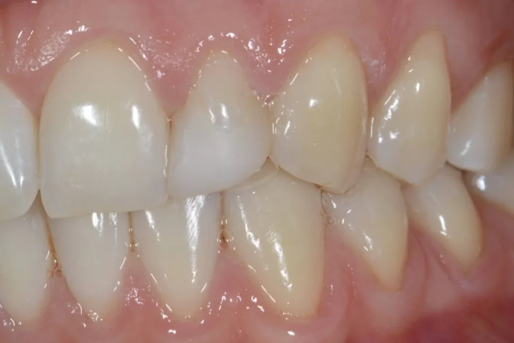 couronne dentaire paris 4 1