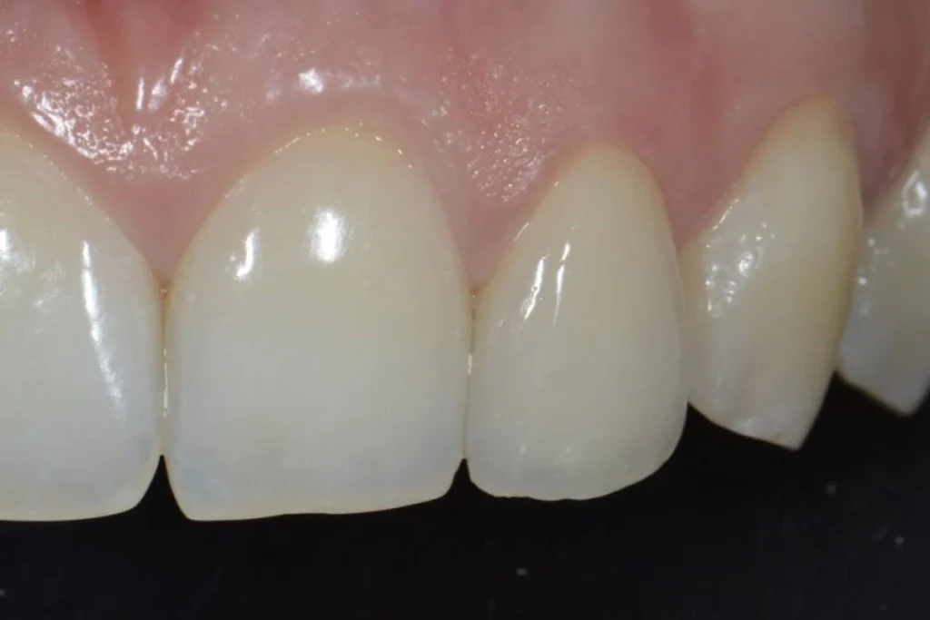 couronne dentaire paris 4 2