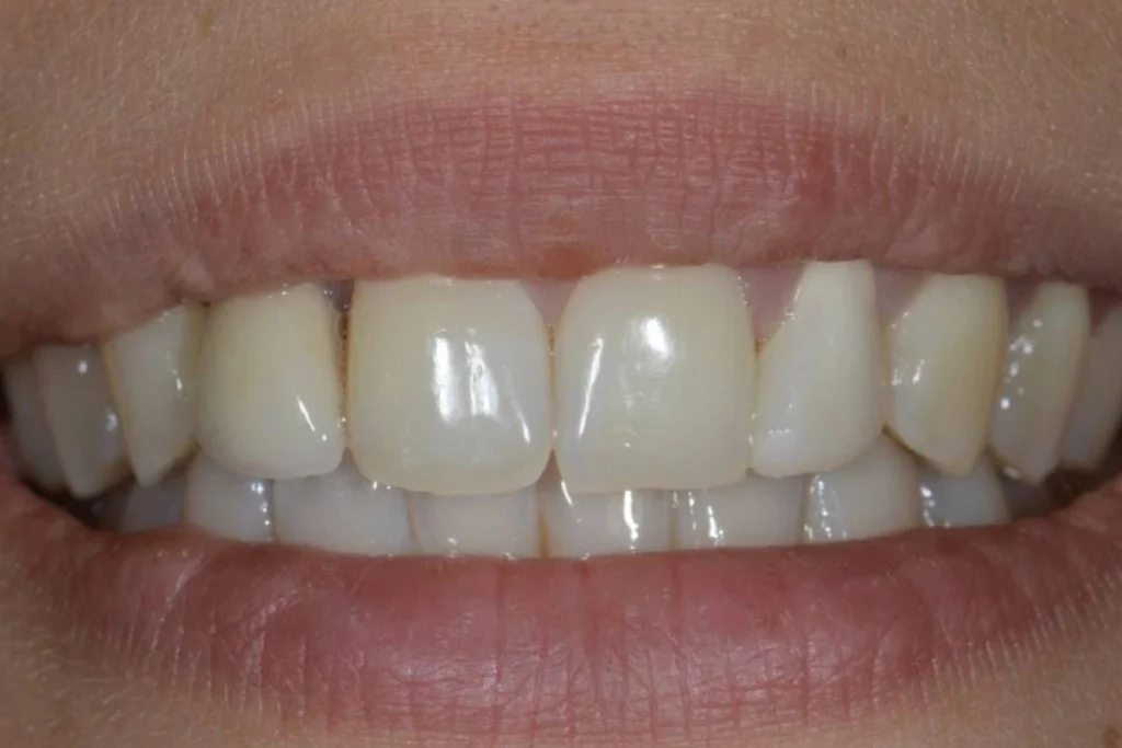 couronne dentaire paris 4 3