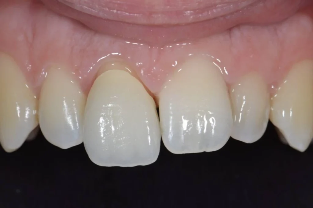 couronne dentaire paris 5 2