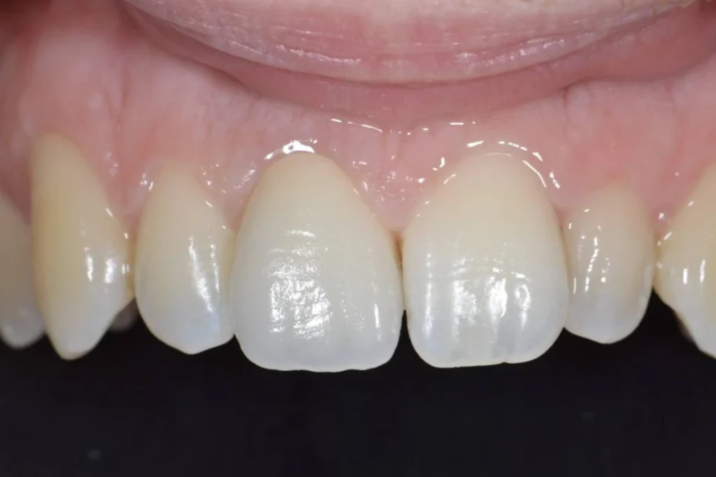 couronne dentaire paris 5 3