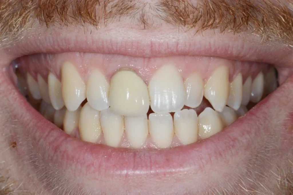 couronne dentaire paris 5 4