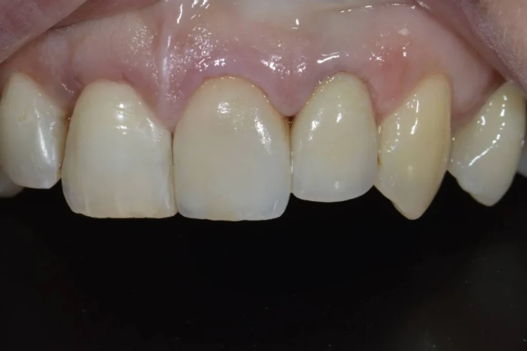 couronne facette dentaire