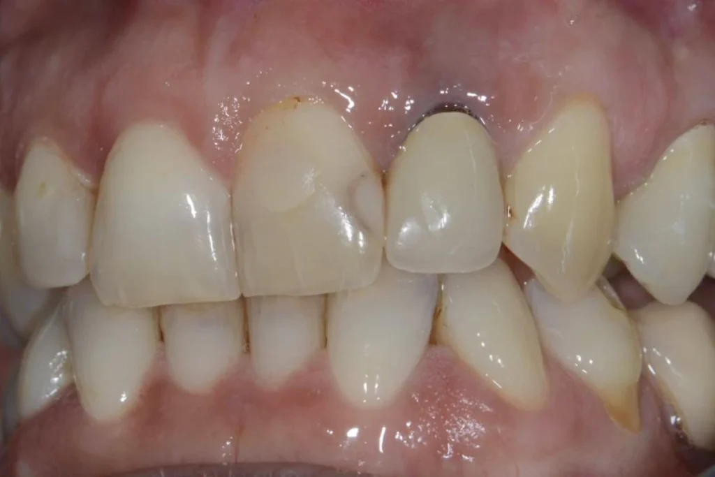 couronne facette dentaire 2