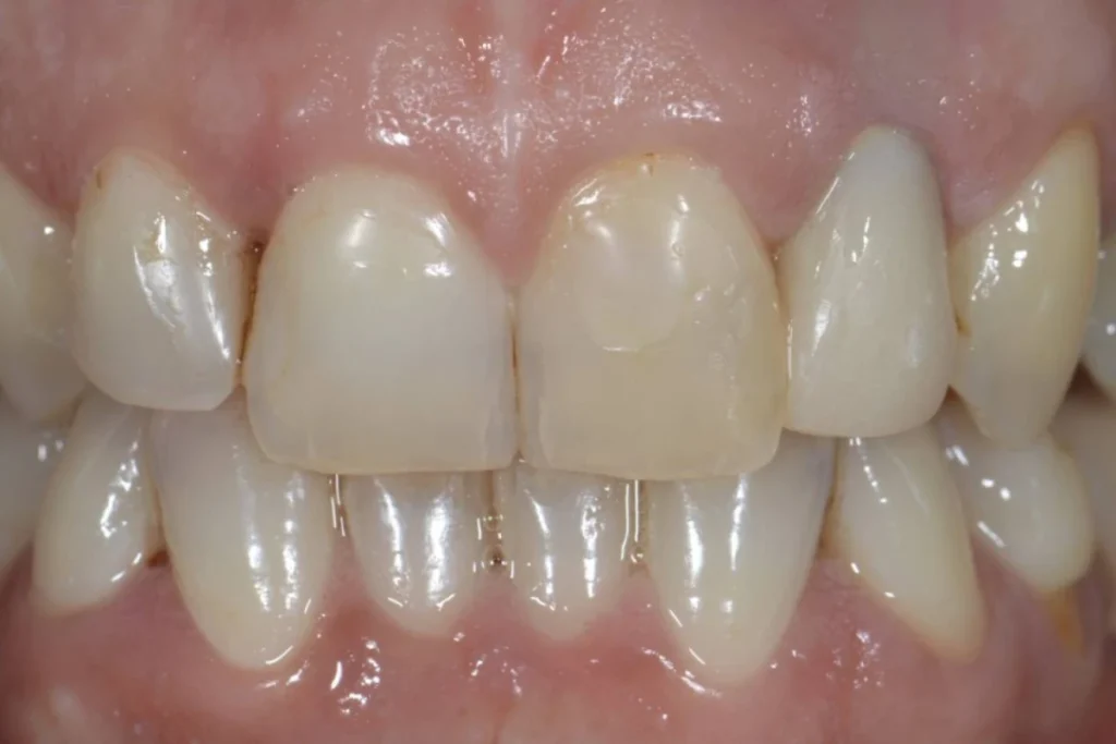 couronne facette dentaire 3