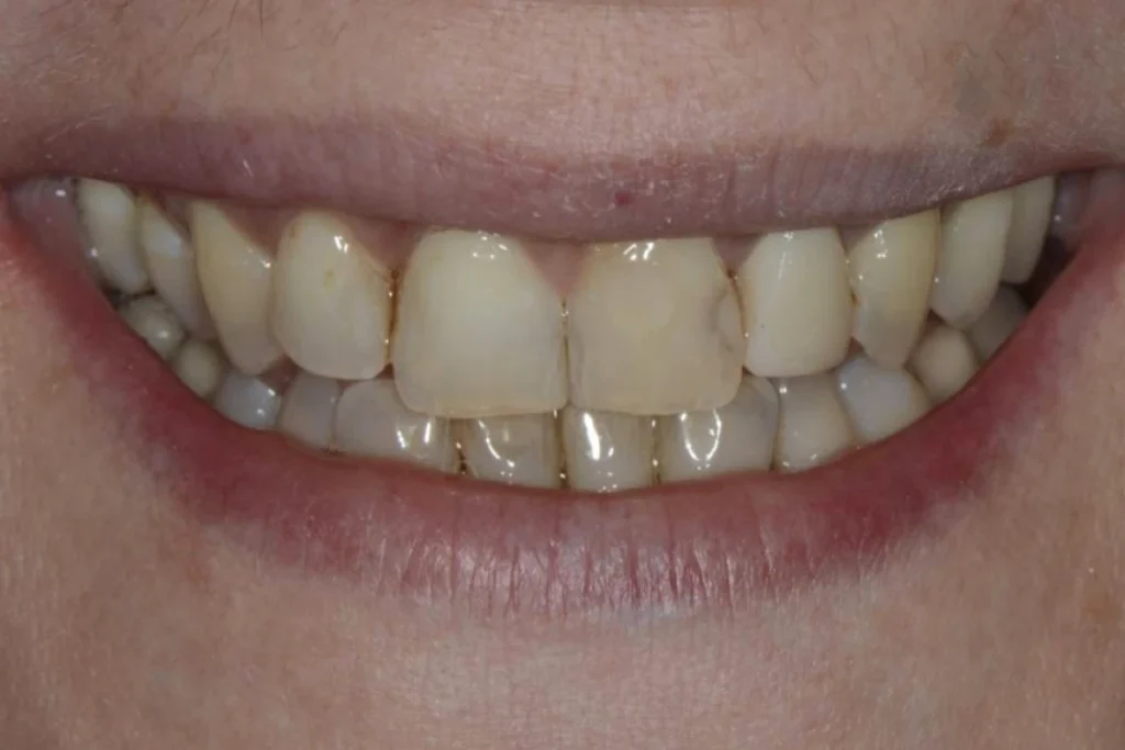 couronne facette dentaire 4