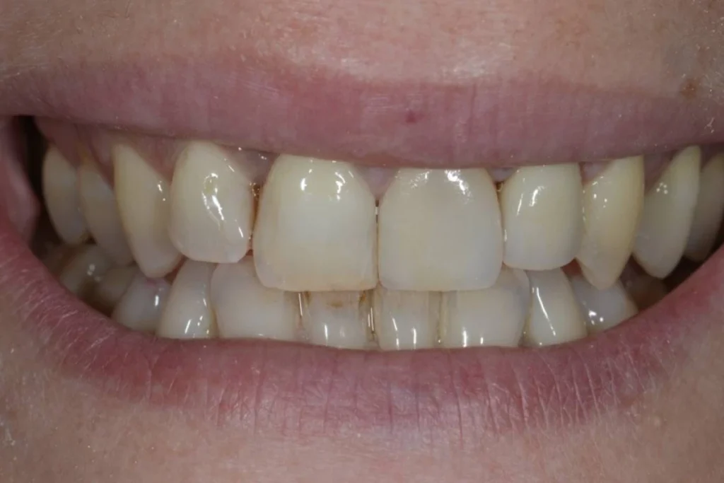 couronne facette dentaire 5