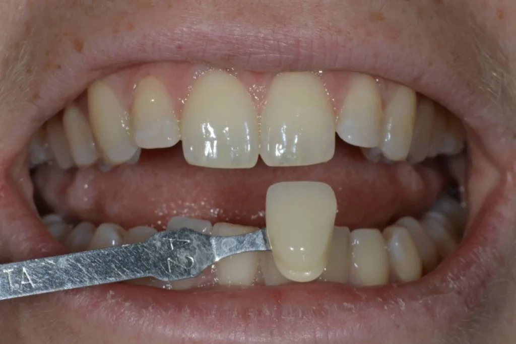 eclaircissement blanchiment dentaire paris