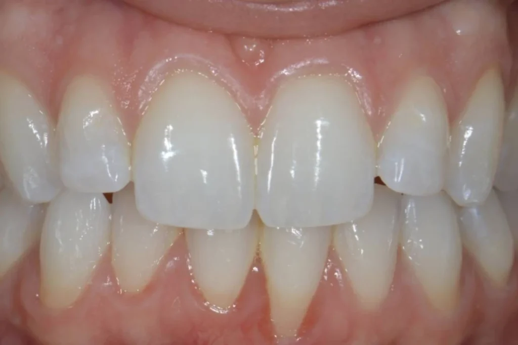 eclaircissement blanchiment dentaire paris 2