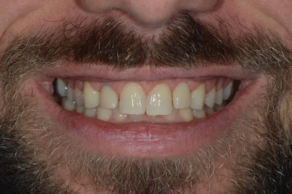 elongation coronaire paris 1