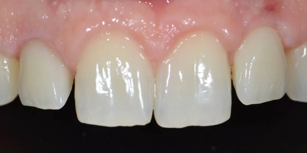 elongation coronaire paris 2