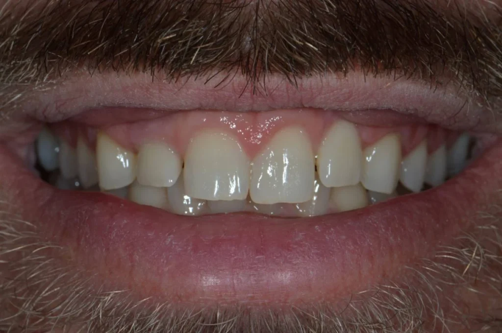 elongation coronaire paris 3