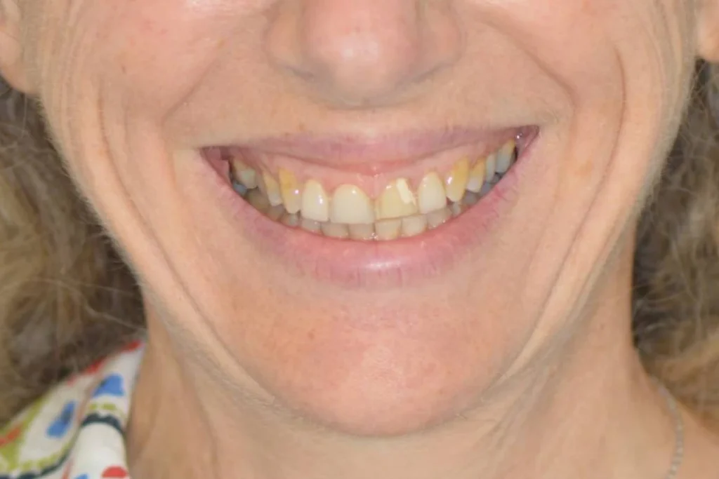 facettes dentaire paris 3 1