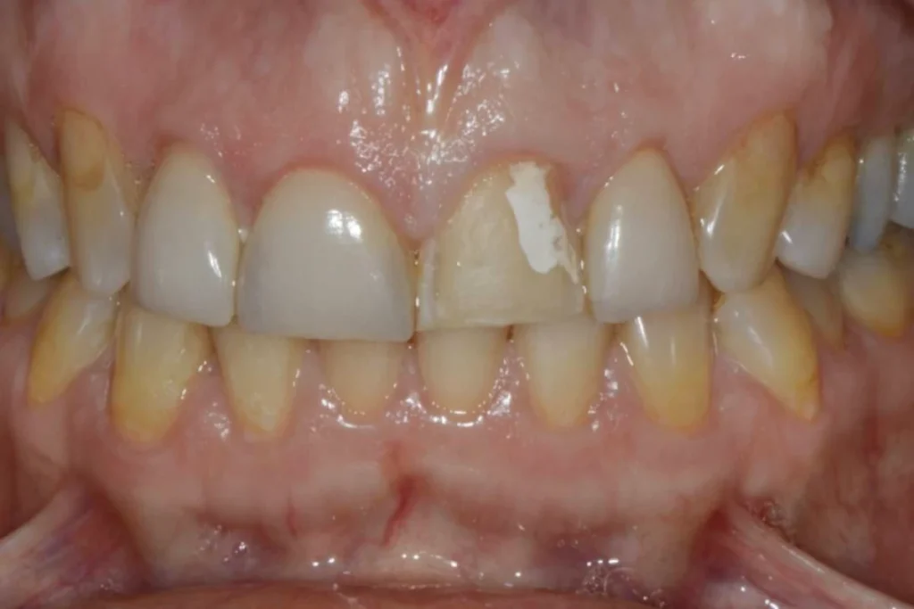 facettes dentaire paris 3 2