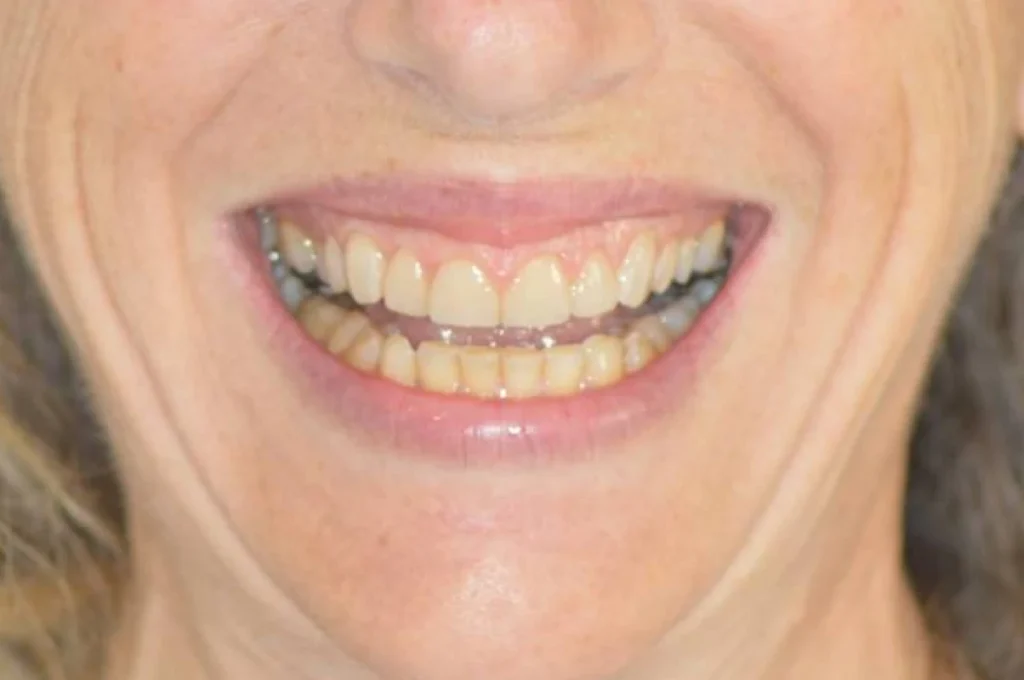 facettes dentaire paris 3 3