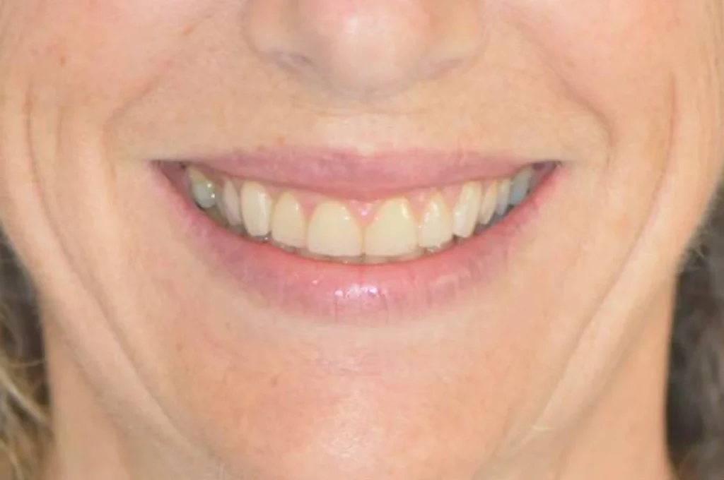 facettes dentaire paris 3 4