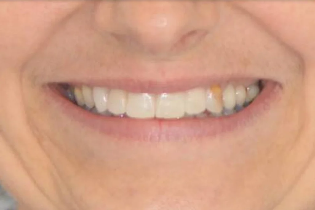 facettes dentaires paris