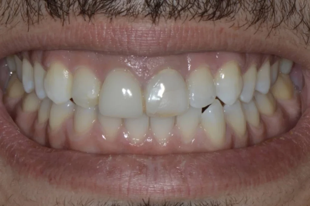 facettes dentaires paris 2 1