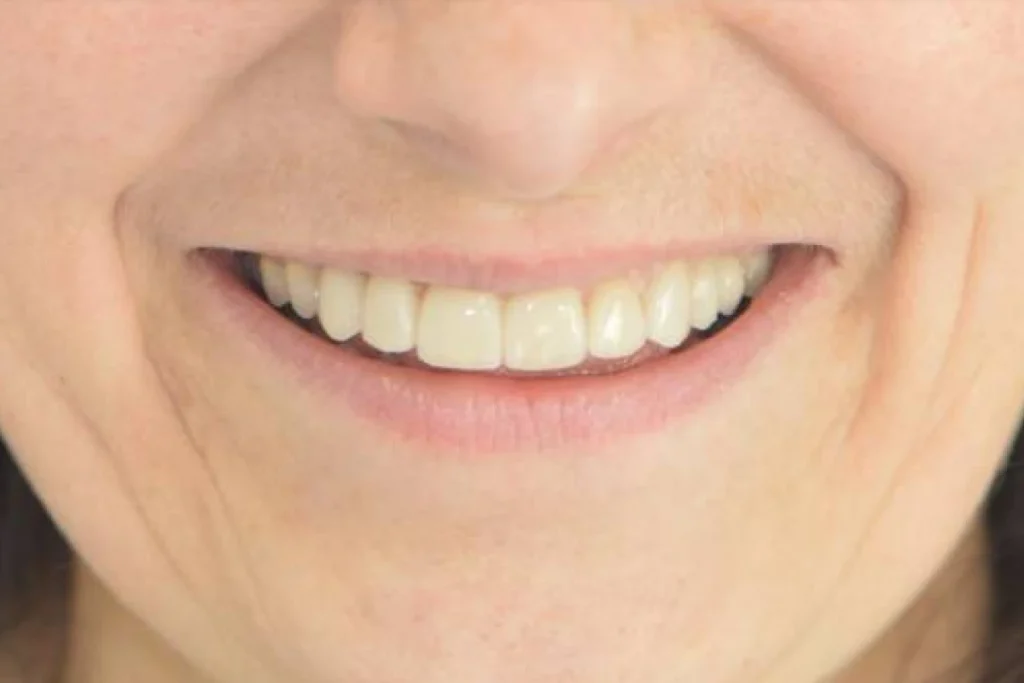 facettes dentaires paris 2