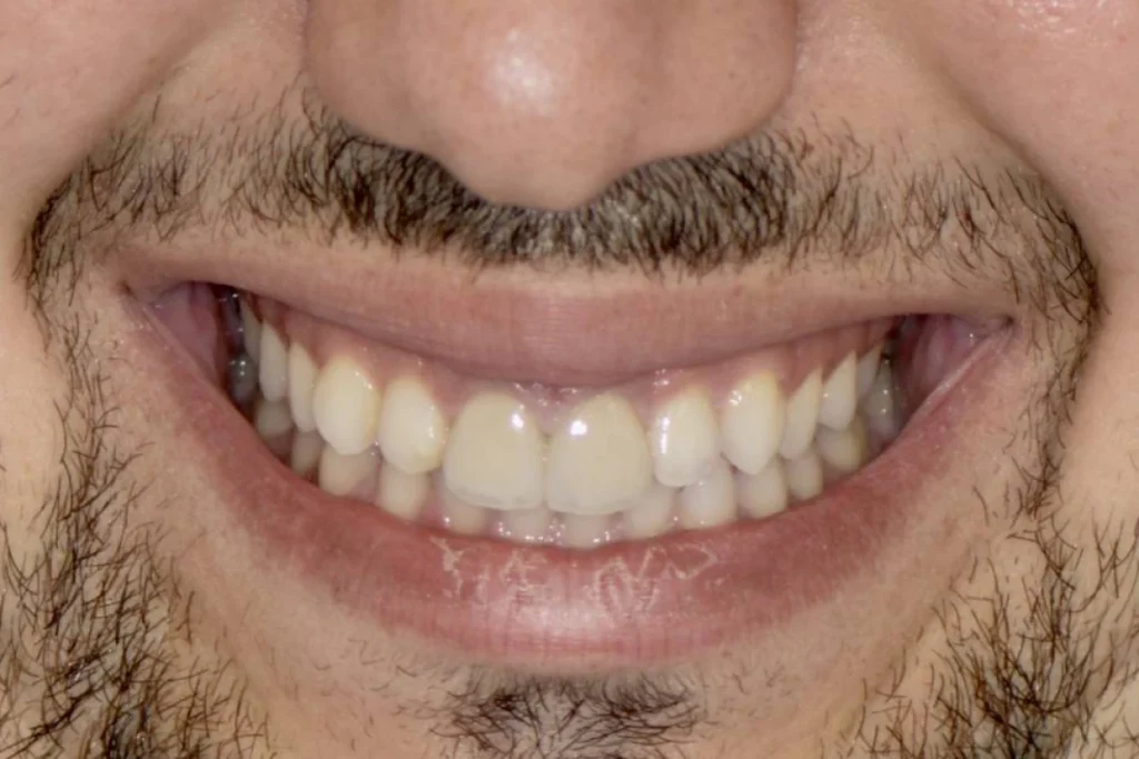 facettes dentaires paris 2 2