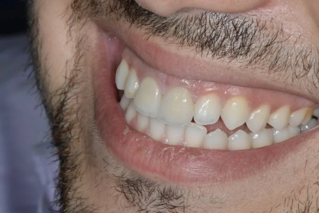 facettes dentaires paris 2 3