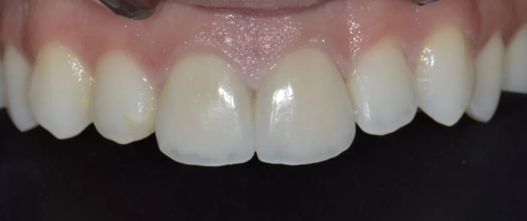 facettes dentaires paris 2 4