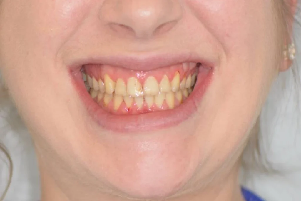 facettes dentaires paris 3 1