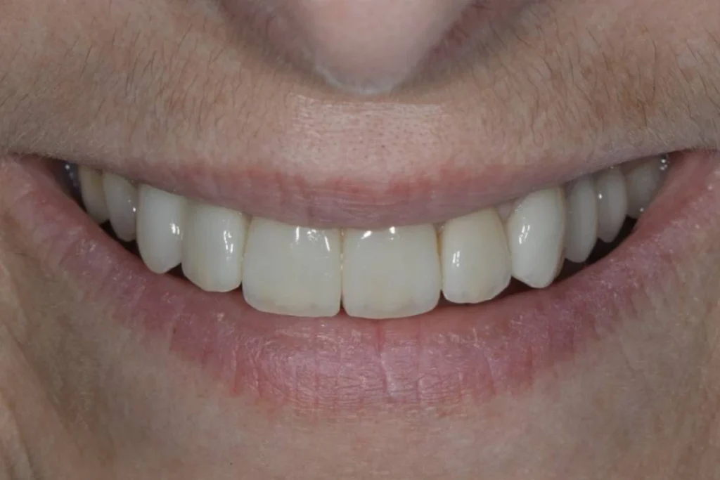 facettes dentaires paris 3