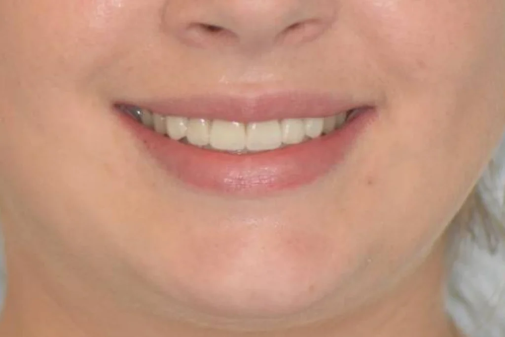 facettes dentaires paris 3 2