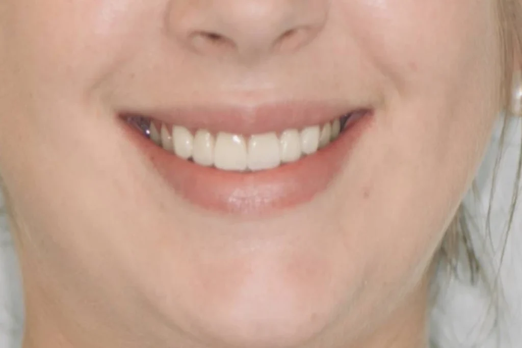 facettes dentaires paris 3 3